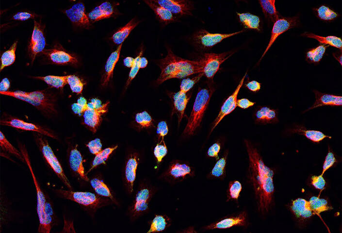 Glioma tumor cells seen under a microscope