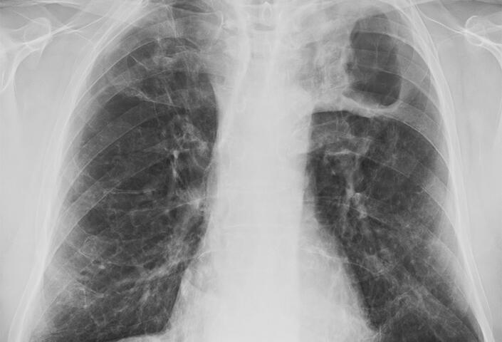 Chest x-ray of severe tuberculosis of the lungs