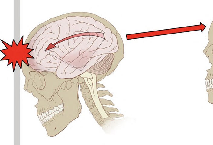 Illustration of a traumatic brain injury (concussion)