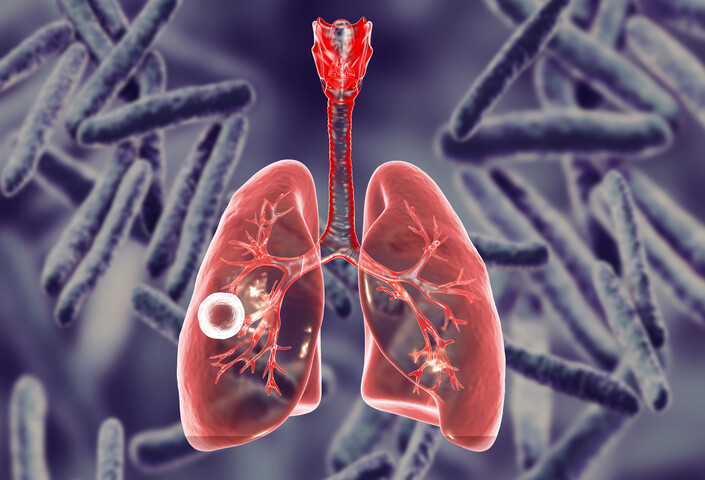 Tuberculosis on the lungs