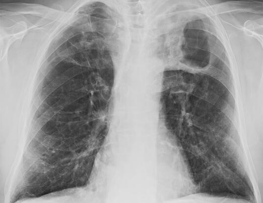 Chest x-ray of severe tuberculosis of the lungs