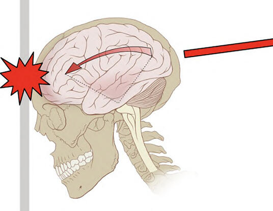Illustration of a traumatic brain injury (concussion)