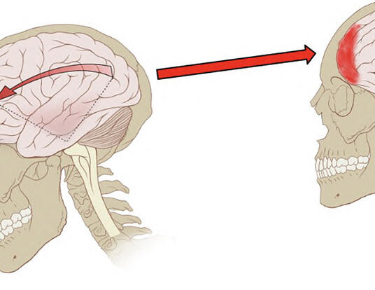 Illustration of a traumatic brain injury (concussion)
