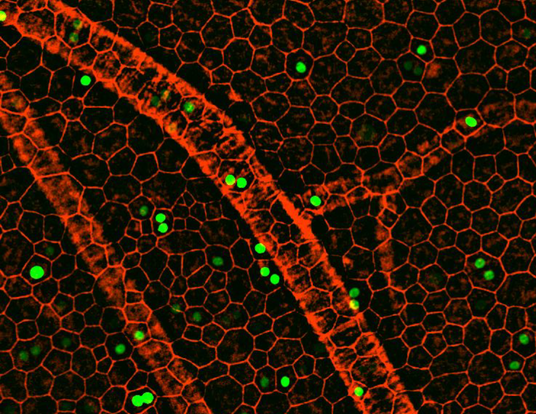 Oxidative stress occurs in diseases that lead to vision loss, including age-related macular degeneration (AMD).