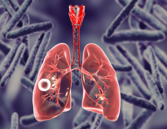 Tuberculosis on the lungs