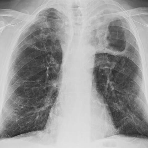 Chest x-ray of severe tuberculosis of the lungs