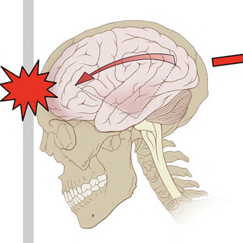 Illustration of a traumatic brain injury (concussion)