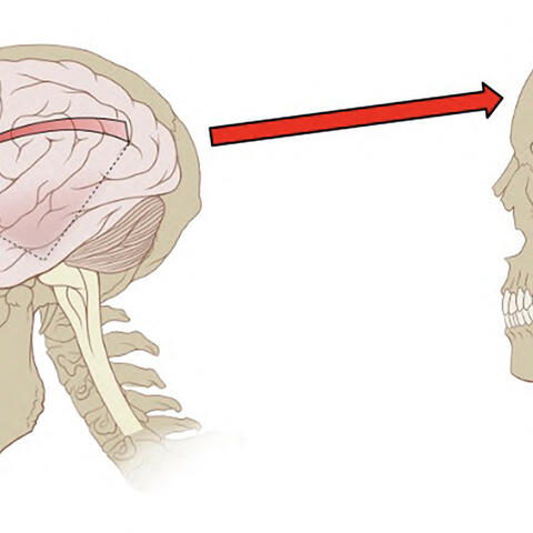 Illustration of a traumatic brain injury (concussion)
