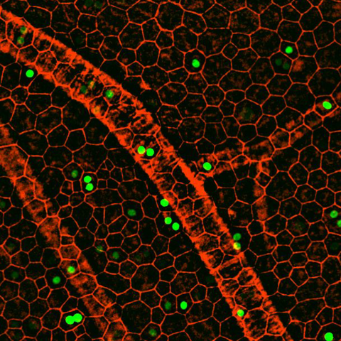 Oxidative stress occurs in diseases that lead to vision loss, including age-related macular degeneration (AMD).